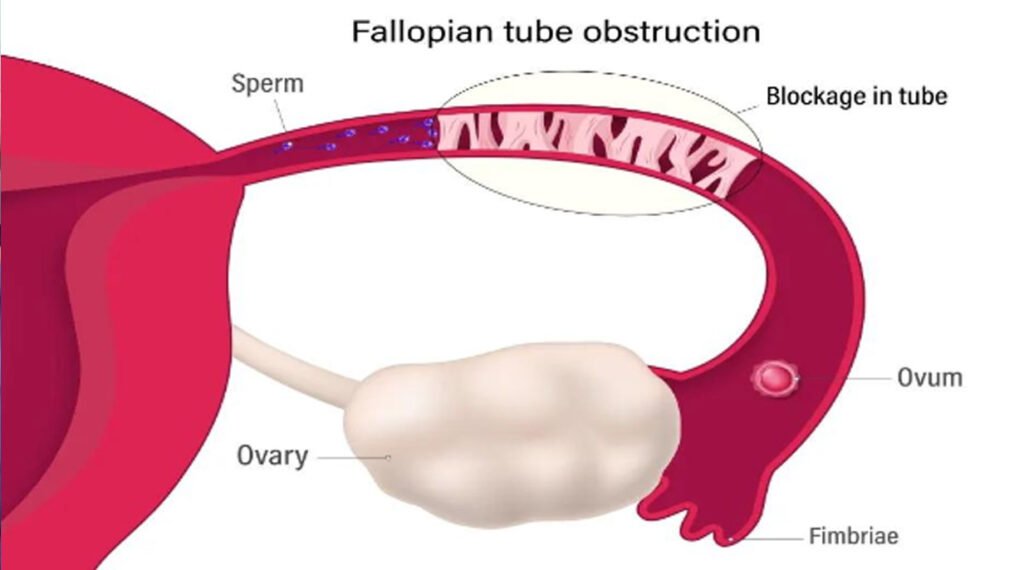 How does fallopian tubes gets blocked